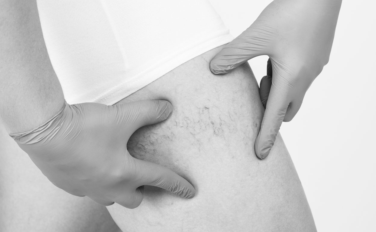 Trattamento-dei-capillari-con-Laser-Terapia
