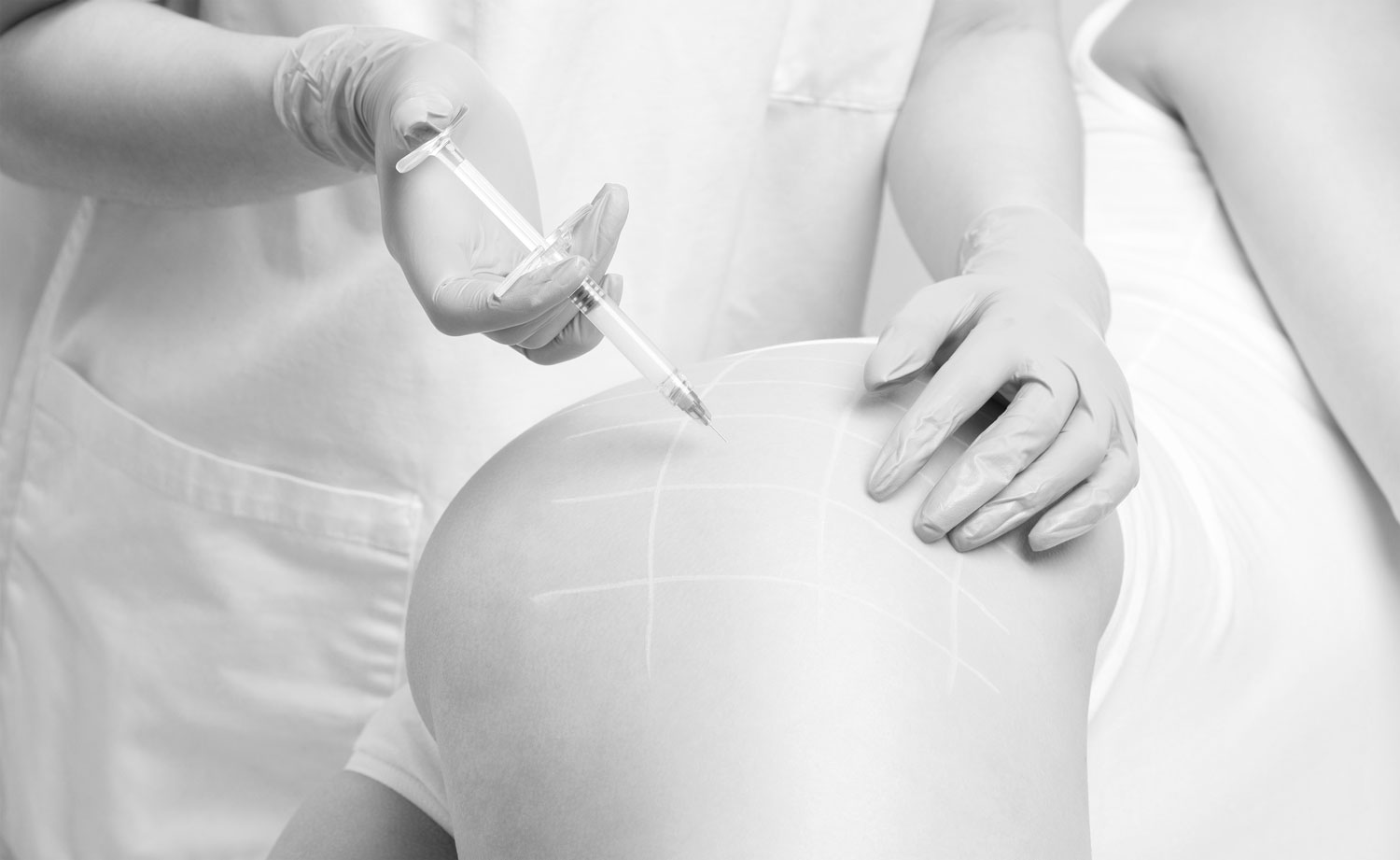 lipofilling-e-liposcultura