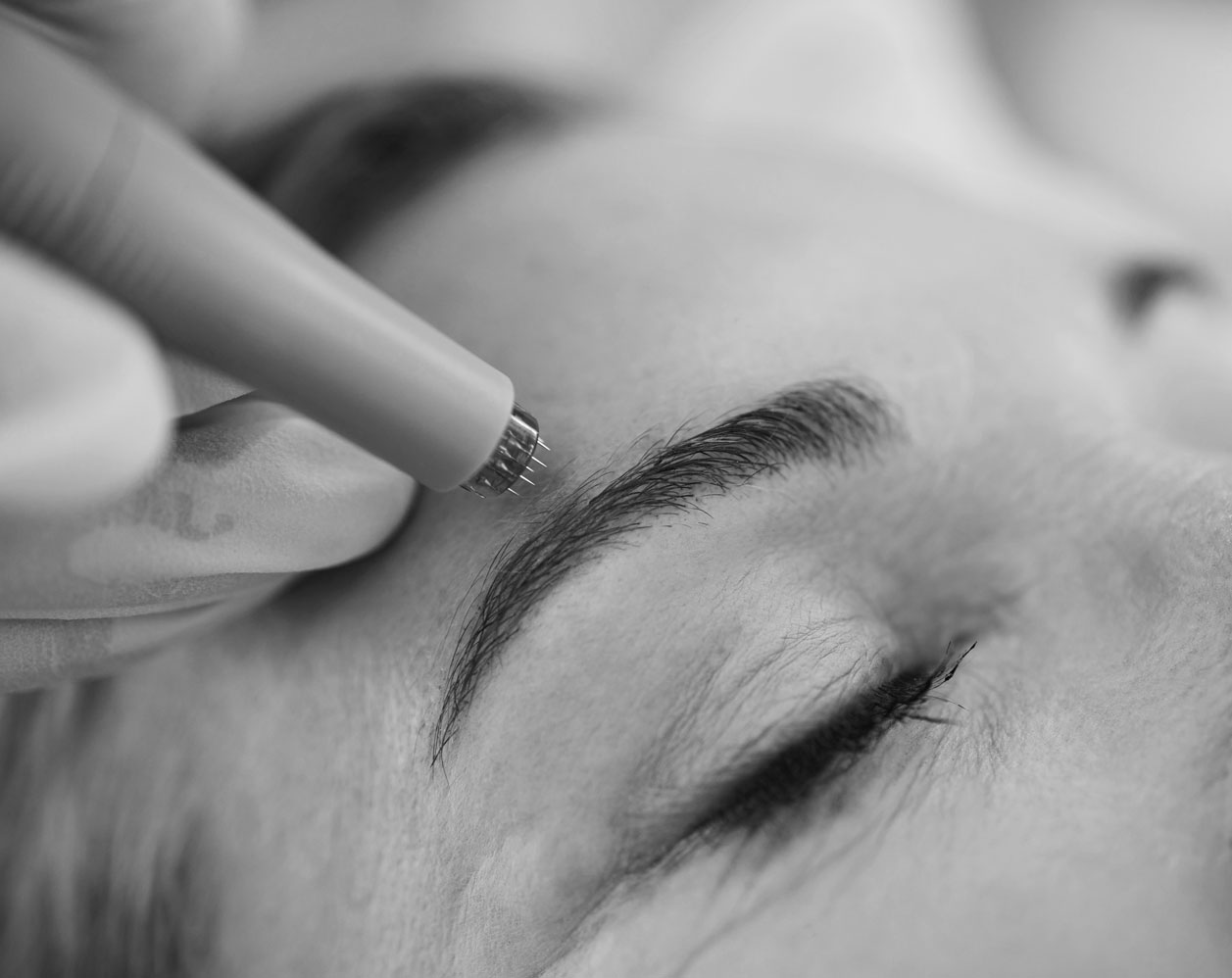microneedling