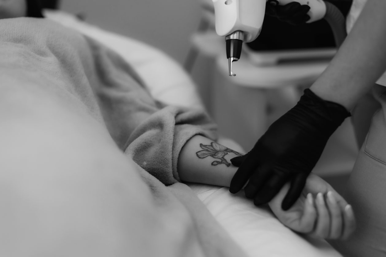 rimozione-macchie-e-tatuaggi